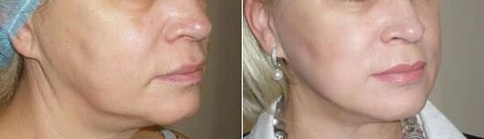 Fotografie după aplicarea procedurii