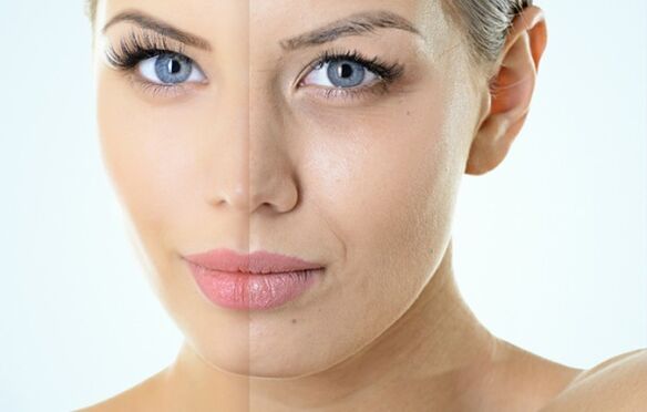 Indicații pentru întinerirea fracțională