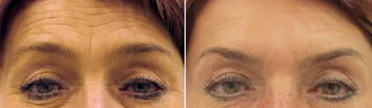 Întinerirea pe teren a frunții